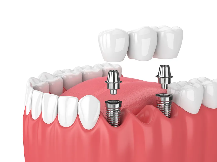 Restoring Smiles with Dental Implants: A Comprehensive Guide