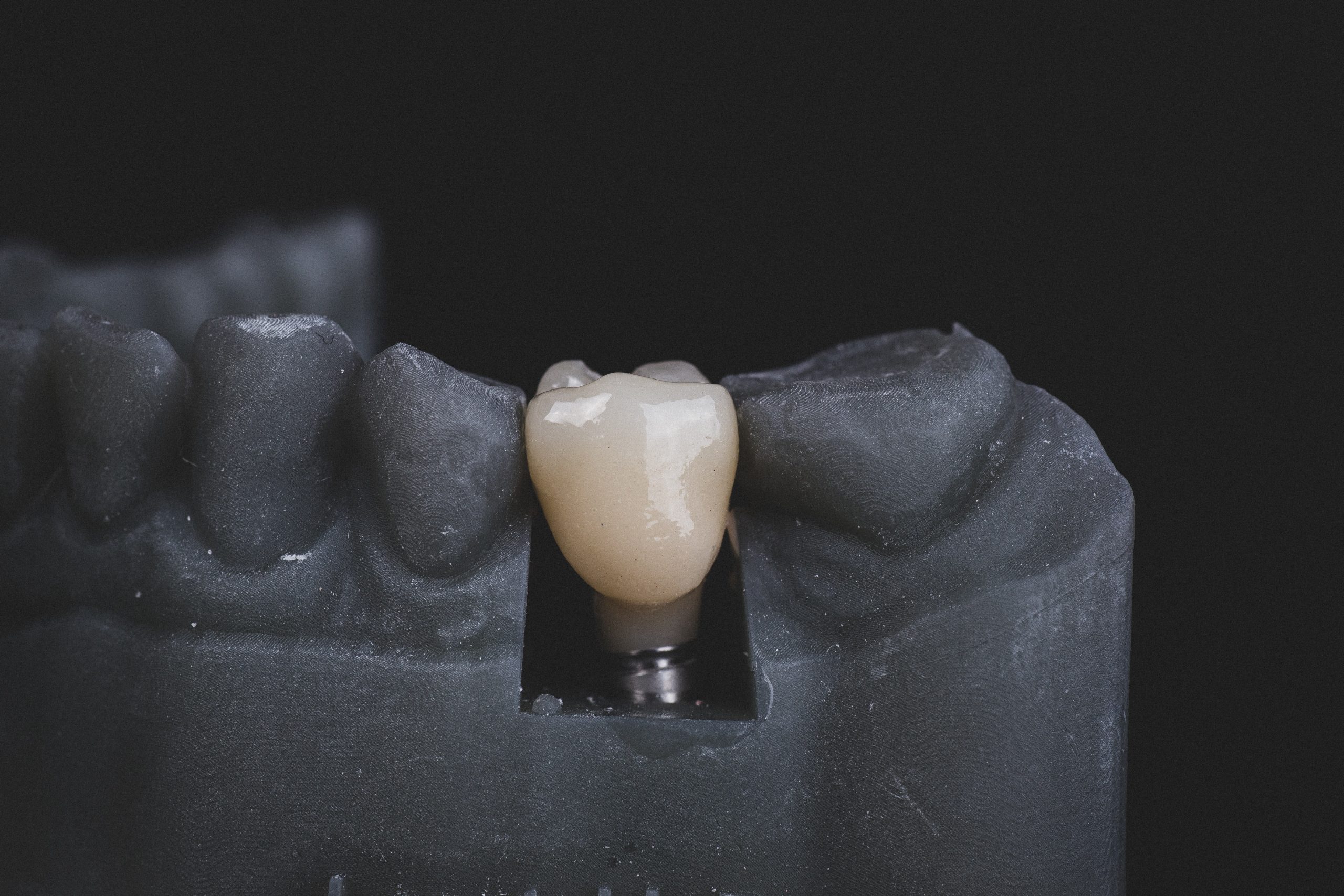 The Complete Guide to Dental Implants: Why They’re the Best Choice for Restoring Your Smile in San Ramon, CA