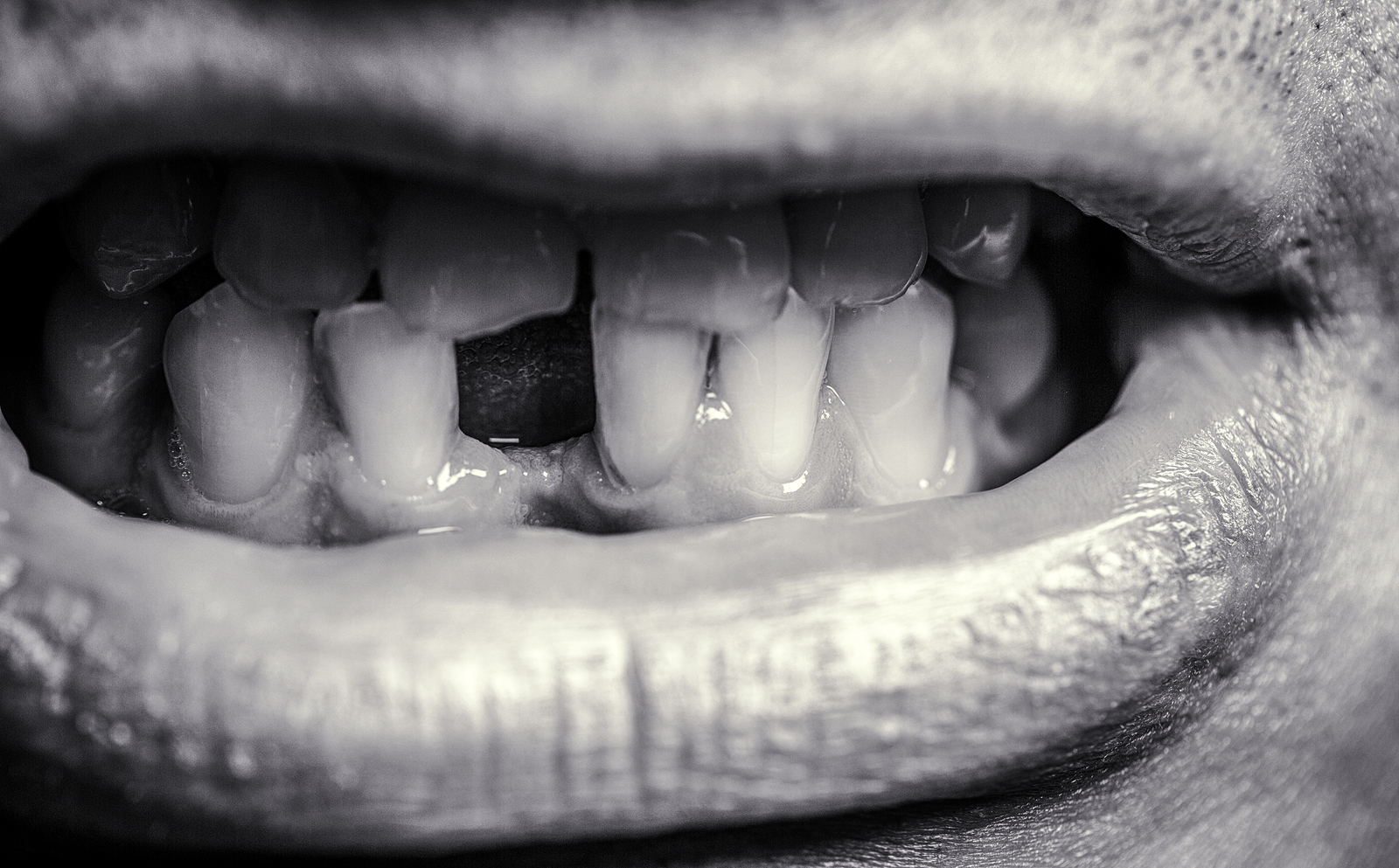 Tooth trauma – What to do if you hit your tooth or get it knocked out?